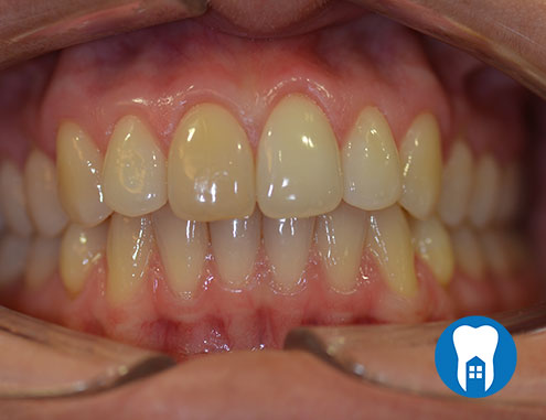 Home teeth whitening - before - Case 1
