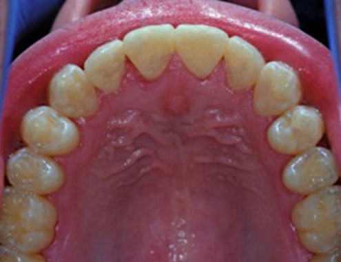 Inman Aligners - after - Case 2