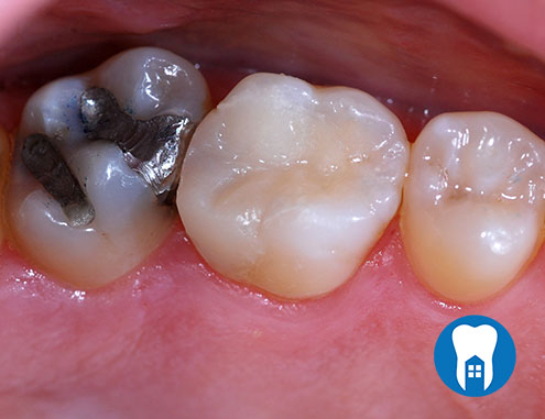 Replacing decayed amalgam filling with composite - After