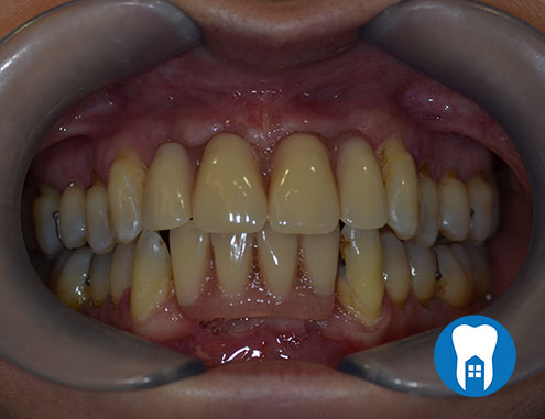 Dentures after - treatment - Case 1